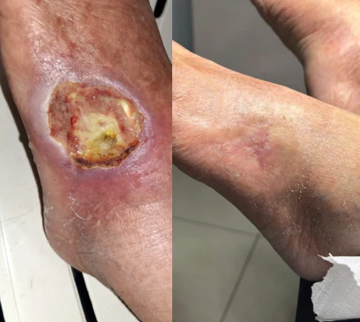 Comparação da evolução de uma ferida na perna, antes e depois do acompanhamento